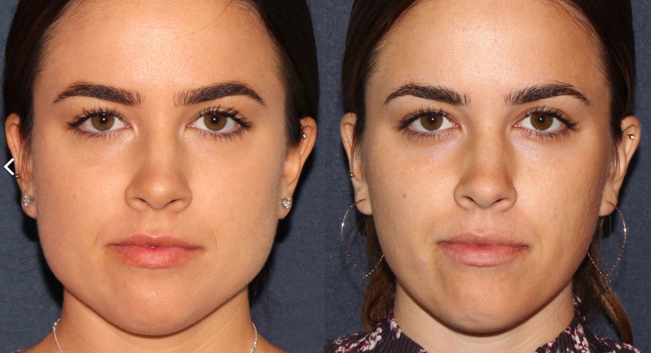Masseter Botox